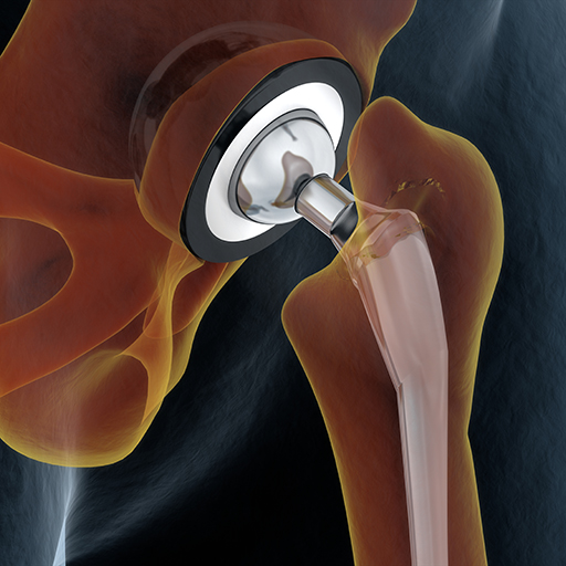 Joint replacement manufacturer